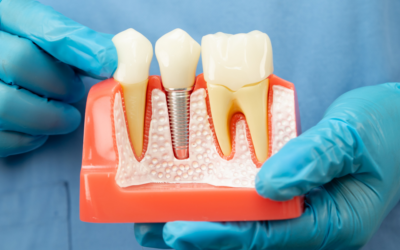 İmplant Uygulamaları