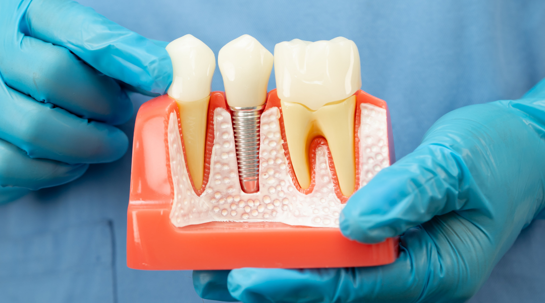 İmplant Uygulamaları